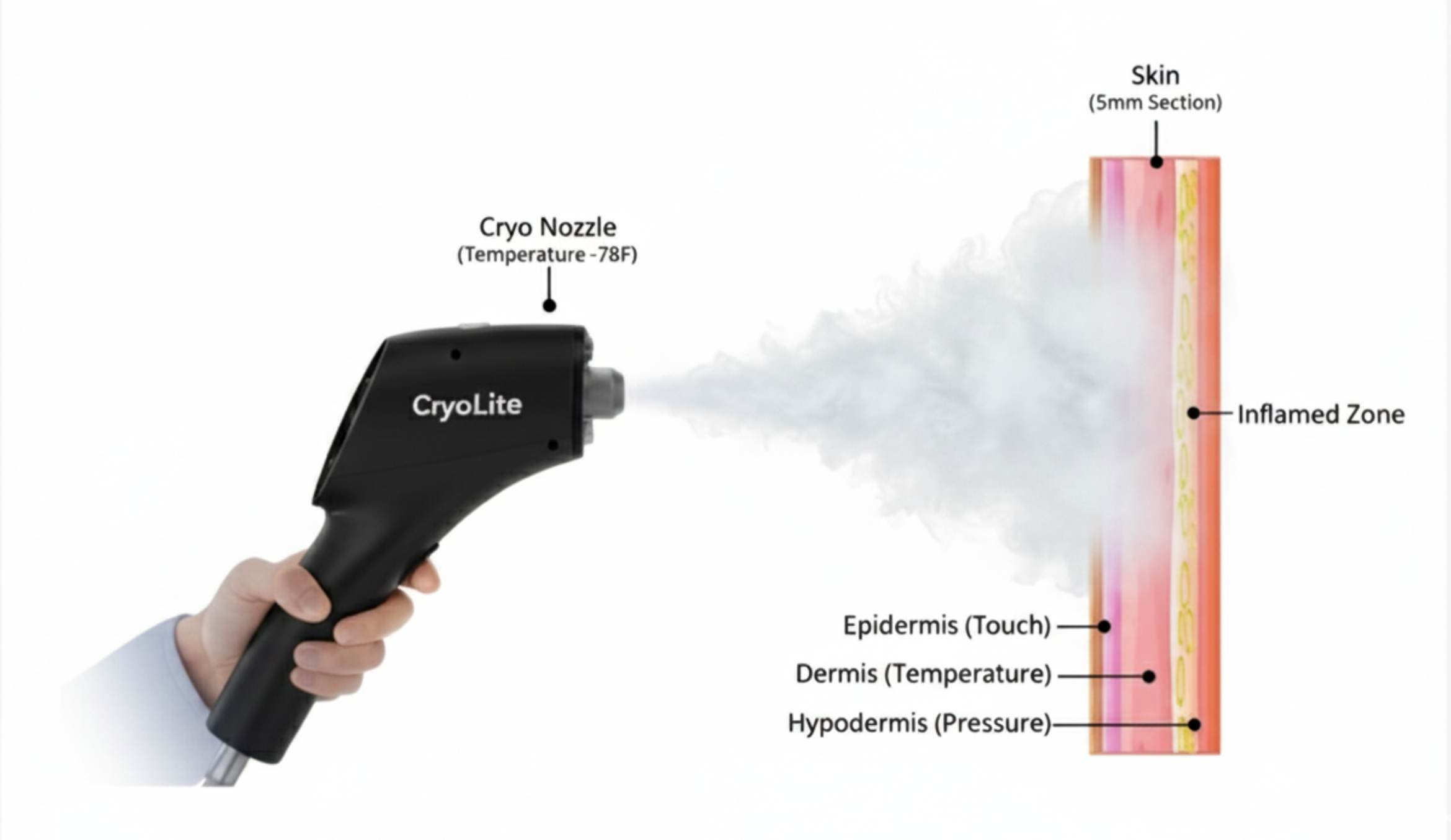 Cyrolyte CryoLite – CryoLiteUSA